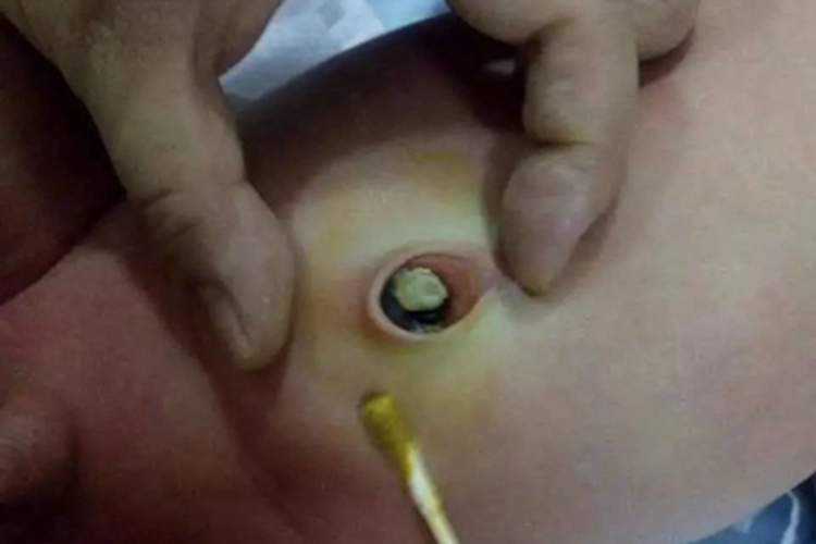 新生儿脐炎肚脐症状图