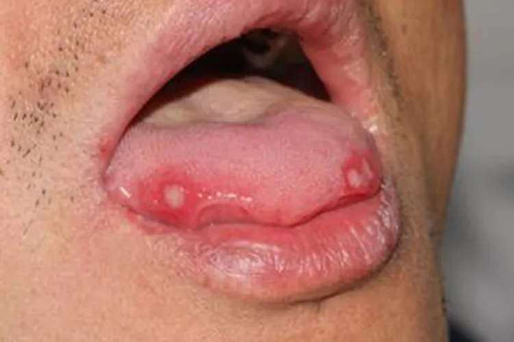 舌头复发性阿弗他溃疡图