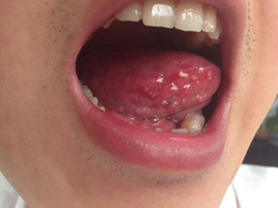 口腔尖锐湿疣舌下有很多疙瘩图.jpg