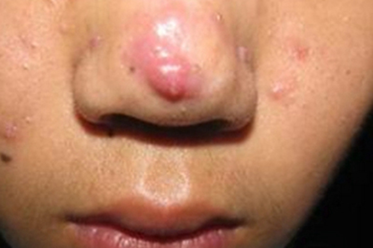 鼻疖鼻尖症状图