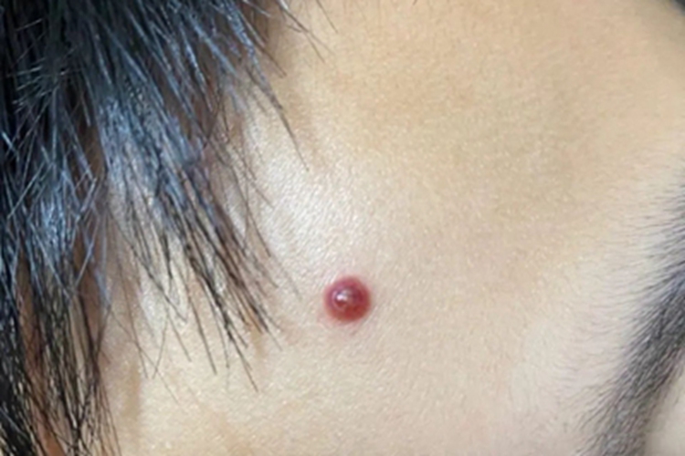 化脓性肉芽肿丘疹图