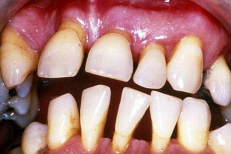 牙龈萎缩牙缝增宽牙根露出图 牙龈萎缩牙缝增宽牙根露出图