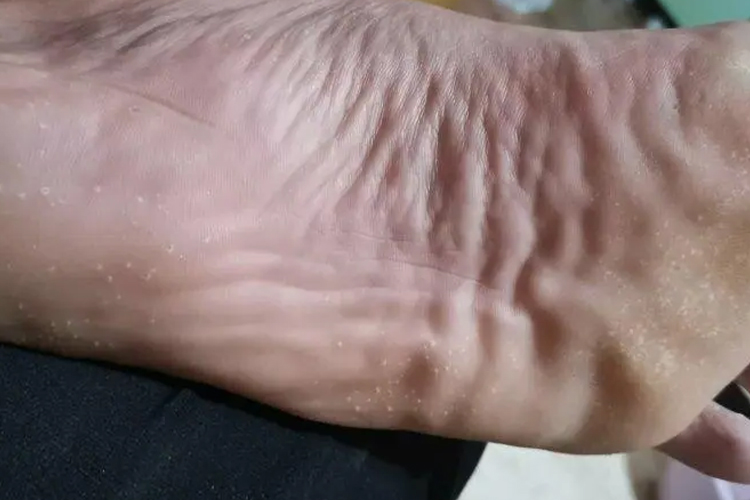 足癣致脚后跟白点图