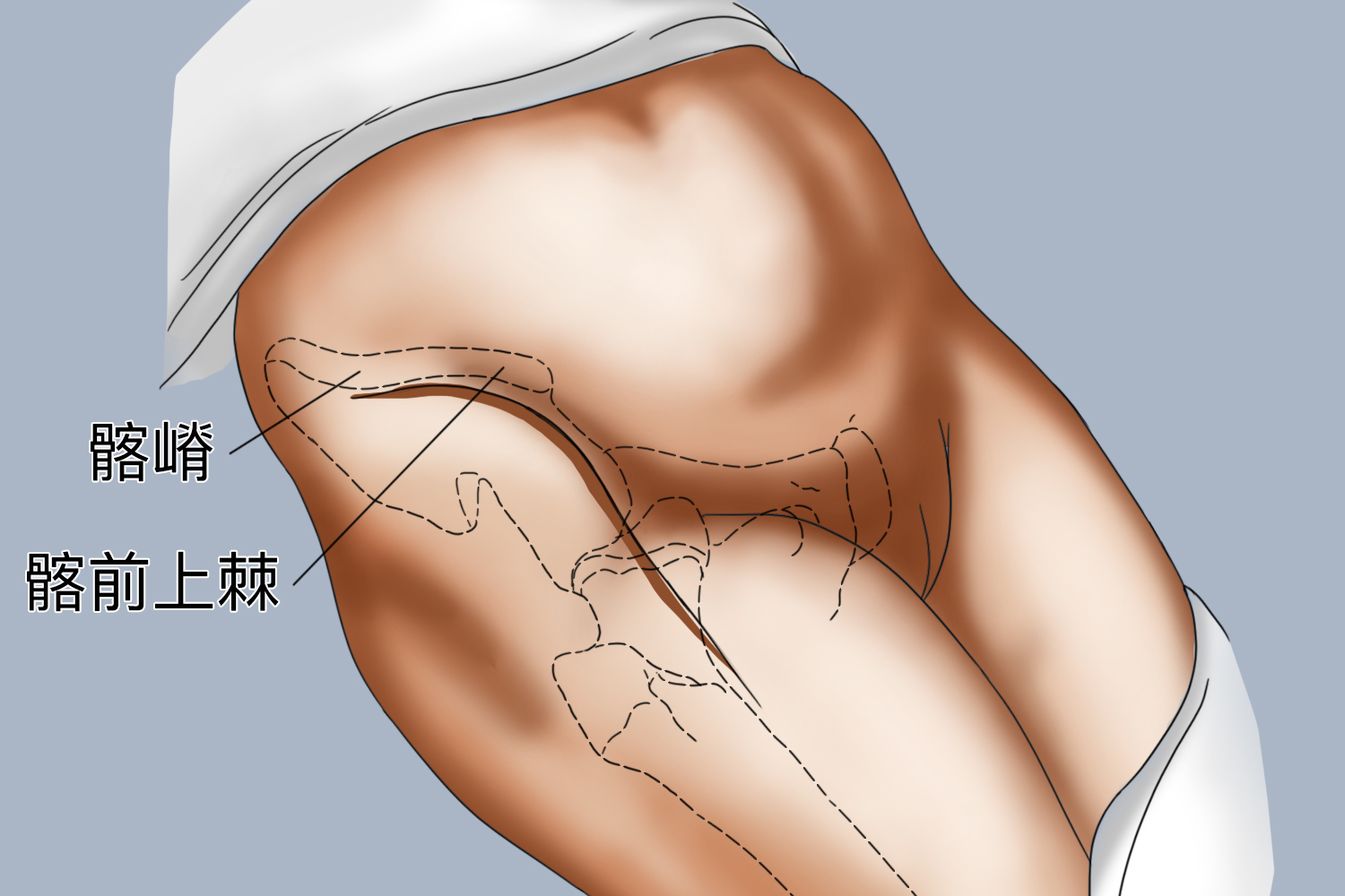 髂嵴和髂前上棘体表位置图