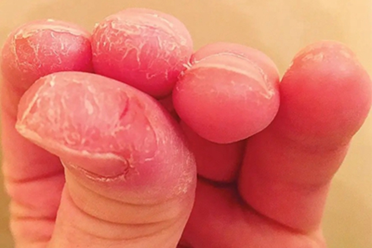 皮肌炎手指尖症状图