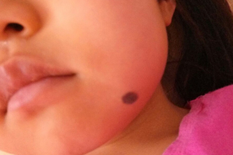 交界痣下巴有圆形黑痣图