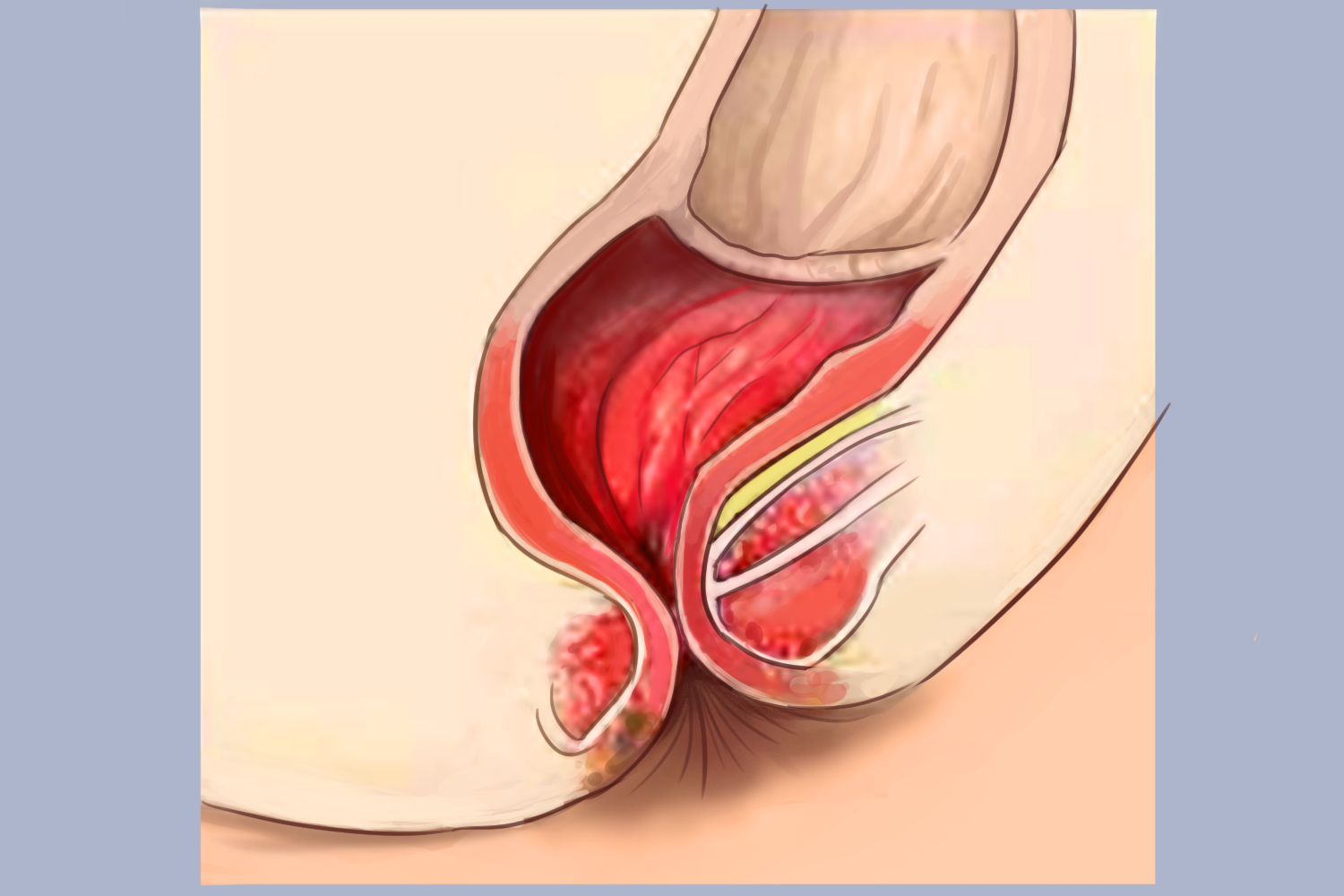婴儿肛门狭窄图