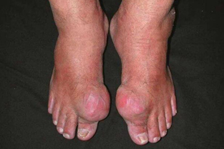 痛风脚趾大红疙瘩图 痛风脚趾大红疙瘩图