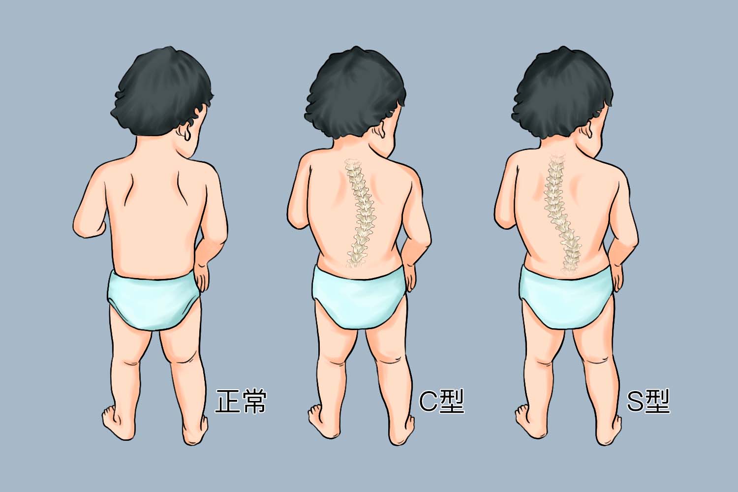 脊柱弯曲正常图片