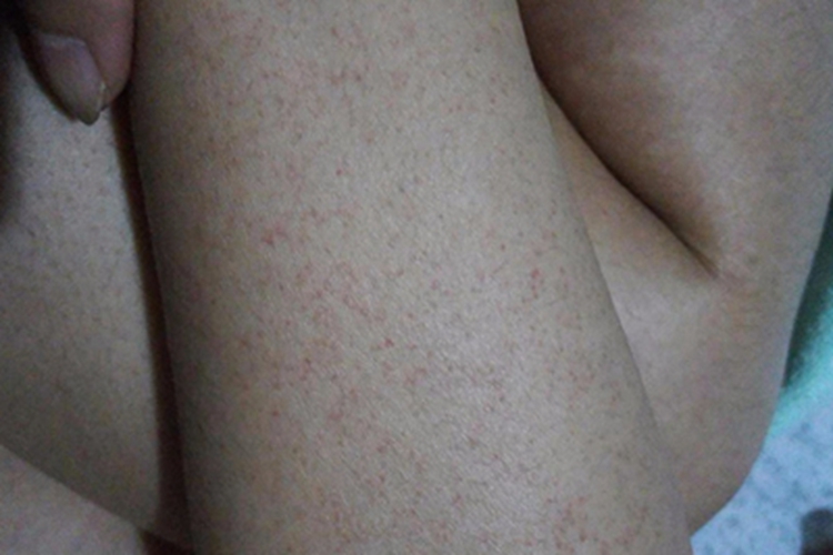 慢性苯中毒胳膊红点图