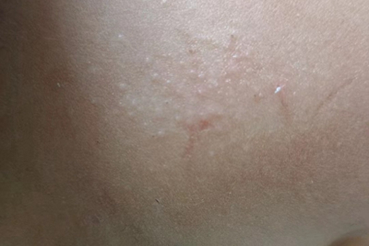 光泽苔藓面部白色丘疹图 光泽苔藓面部白色丘疹图