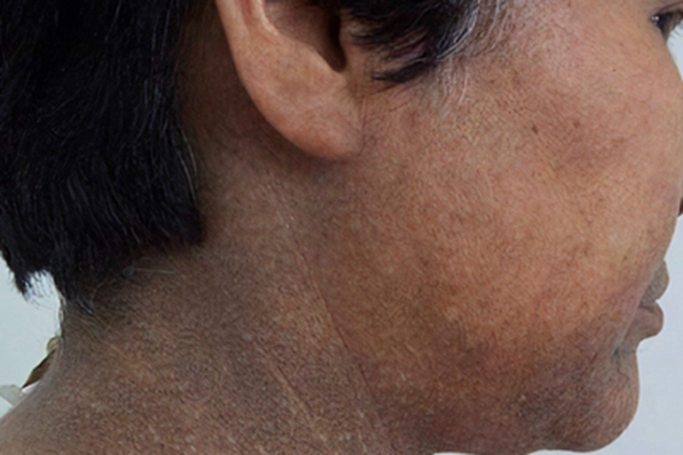 焦油性黑变病颈部症状图 焦油性黑变病颈部症状图