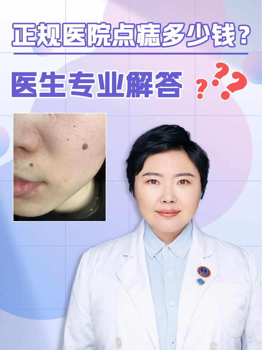 正规医院点痣多少钱？医生专业解答