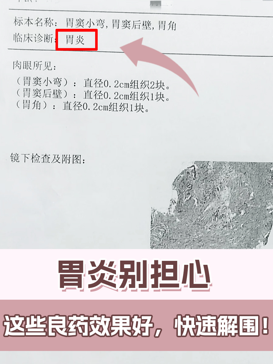 胃炎别担心,这些良药效果好,快速解围!