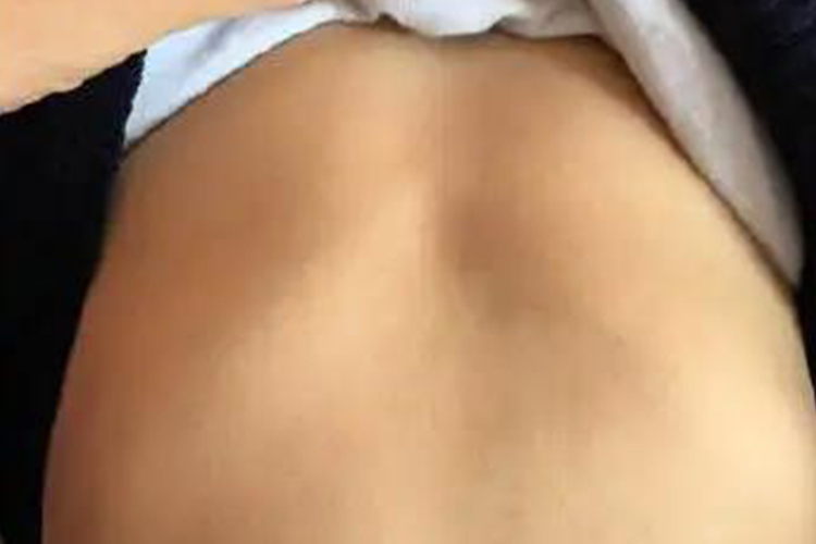 生理性肋骨外翻图 生理性肋骨外翻图