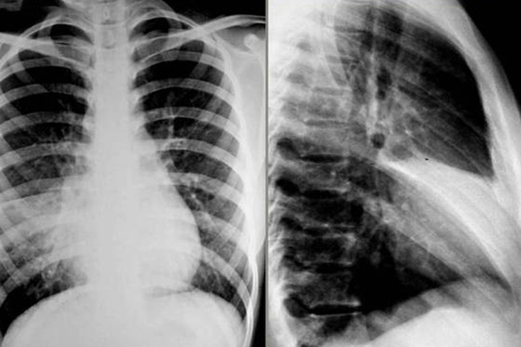 右下内基底段肺不张图