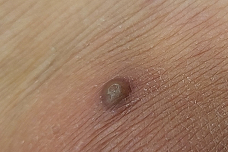 皮脂腺囊肿胳膊结节图