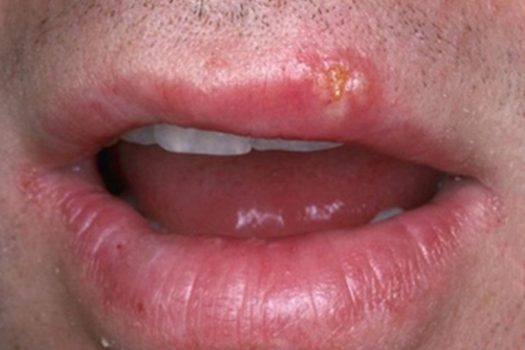 单纯疱疹嘴唇长小水疱结痂图