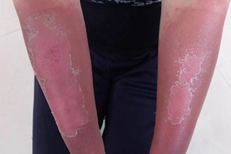 Ⅰ度急性放射性皮炎症状图