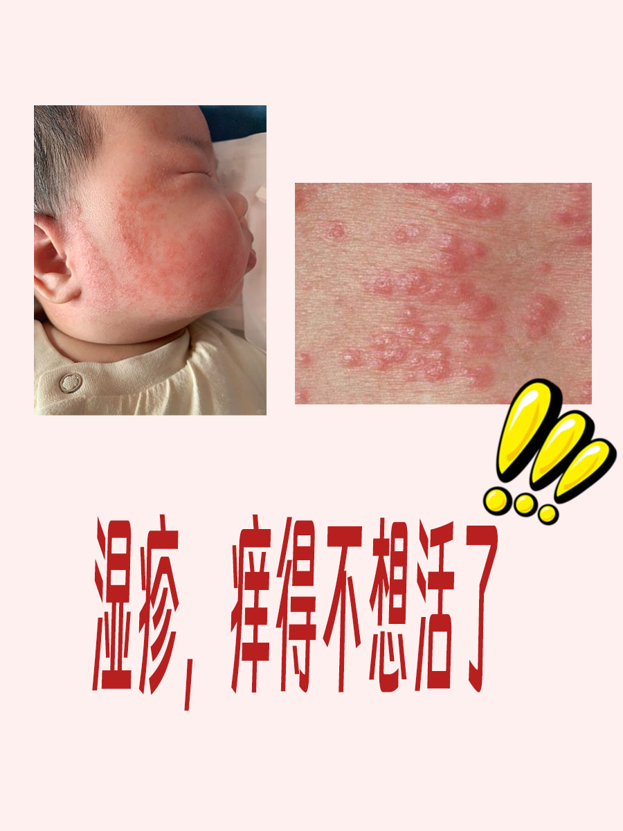 湿疹、疱疹傻傻分不清?教你如何简要判断!