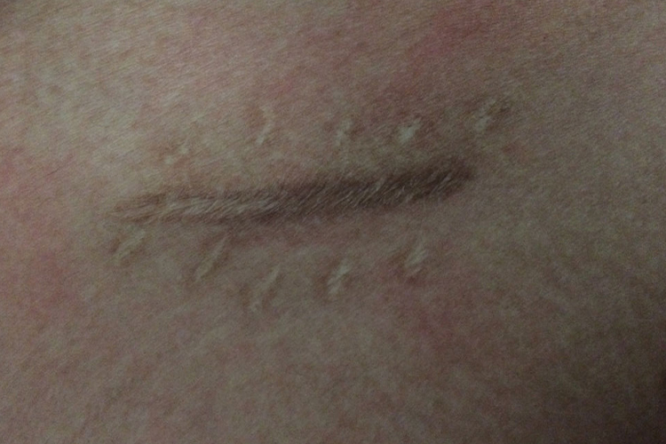 开腹阑尾切除术瘢痕图 开腹阑尾切除术瘢痕图