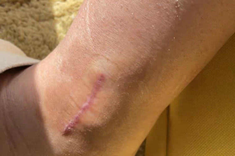 瘢痕疙瘩脚踝瘢痕图