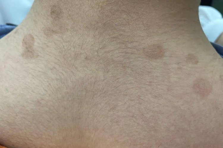 颈部褐色汗斑图