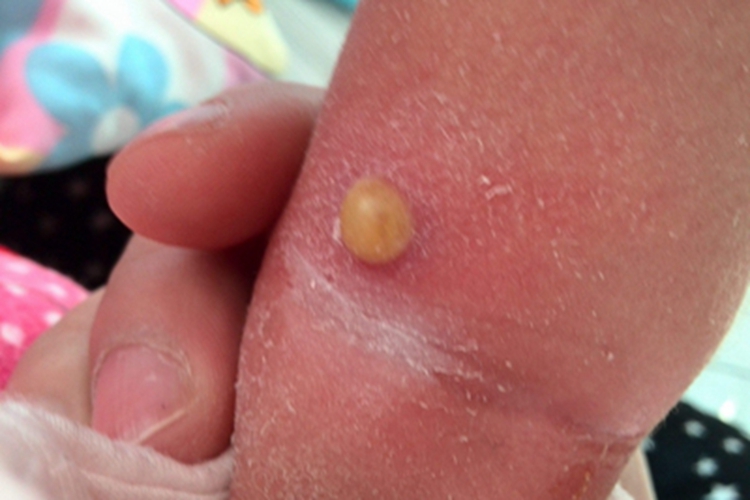 柯萨奇湿疹胳膊脓包图