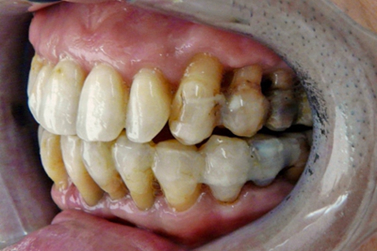 慢性牙周炎牙齿症状图