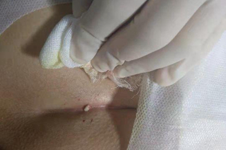 藏毛窦臀部长白色疙瘩图