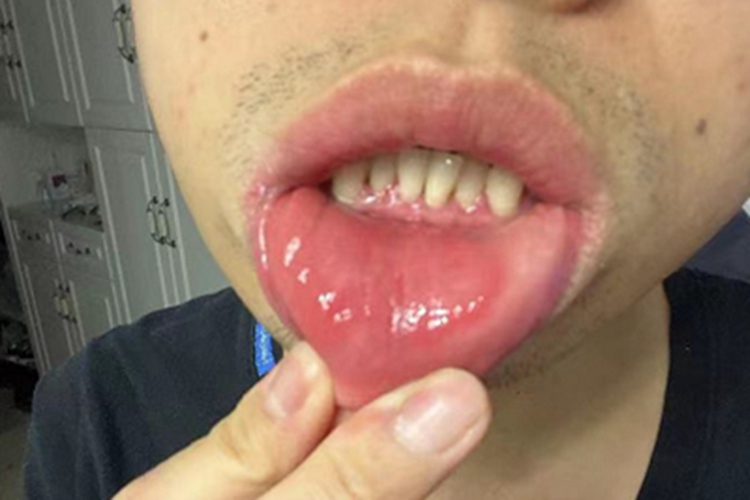 牙龈萎缩下颌中切牙变长图