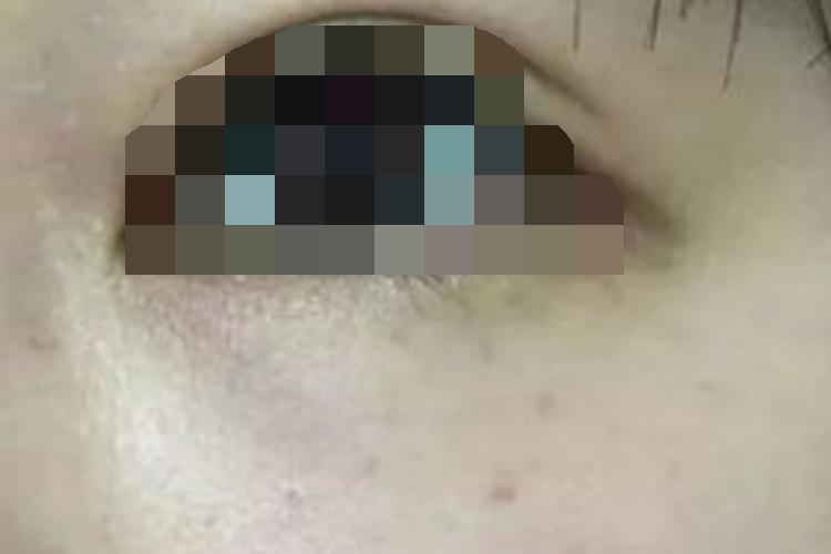 激光祛斑后皮肤逐渐恢复正常图