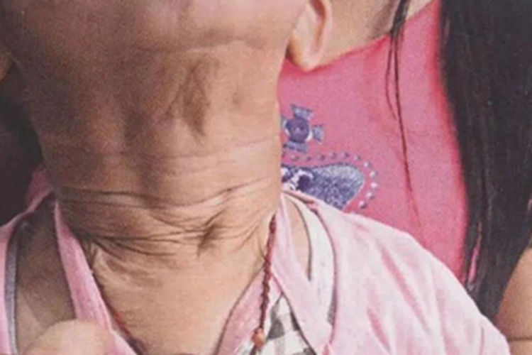 先天性皮肤松弛症颈部松弛图