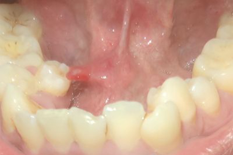 涎腺囊肿肉赘图 涎腺囊肿肉赘图