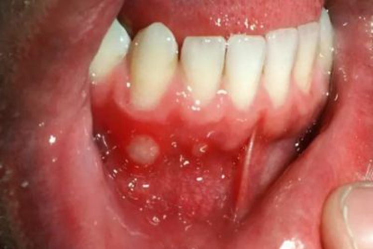 创伤性溃疡症状图 创伤性溃疡症状图