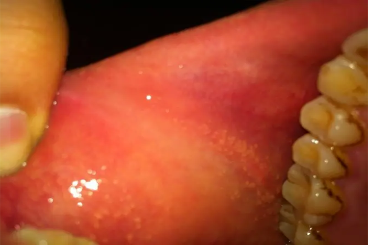 口腔内壁密密麻麻颗粒图