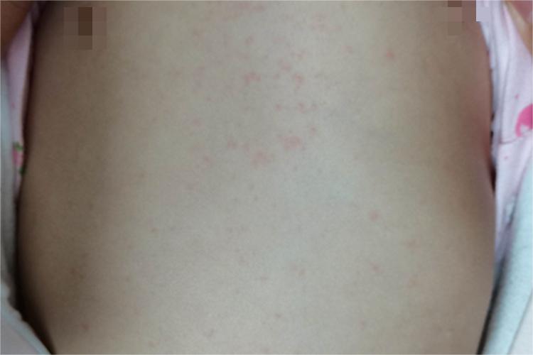 幼儿急疹胸部症状图