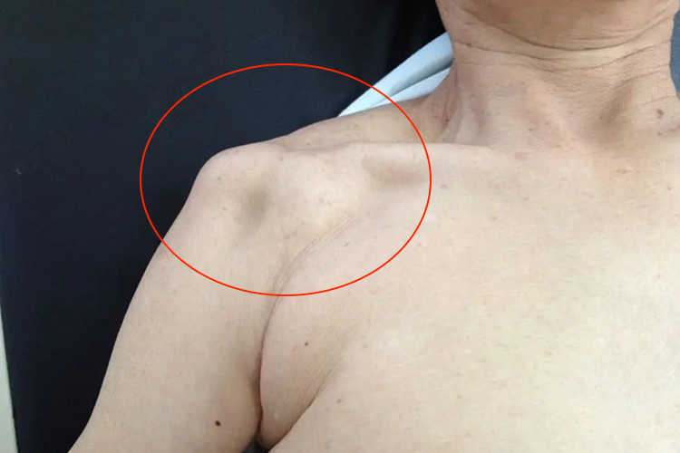 右肩关节盂骨折方肩畸形图