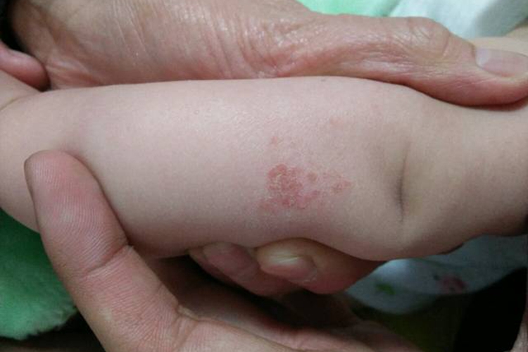 急性湿疹图