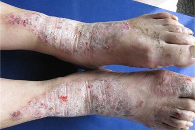 慢性苔藓样角化病脚背症状图 慢性苔藓样角化病脚背症状图