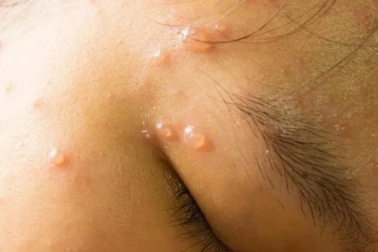 婴儿脸上水痘图