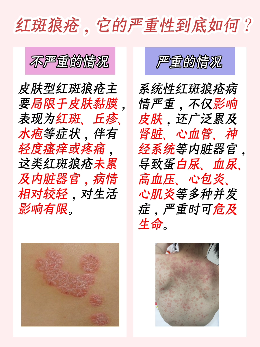 红斑狼疮，病情真的很危急吗？