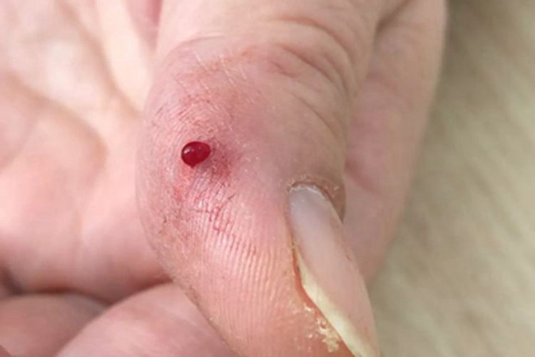 肉芽肿型血管瘤手指小红疙瘩图