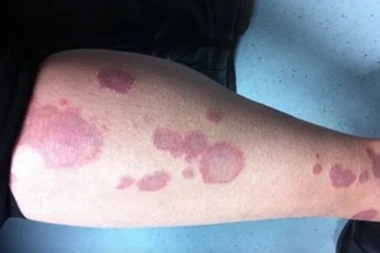 远心性环状红斑小腿症状图 远心性环状红斑小腿症状图