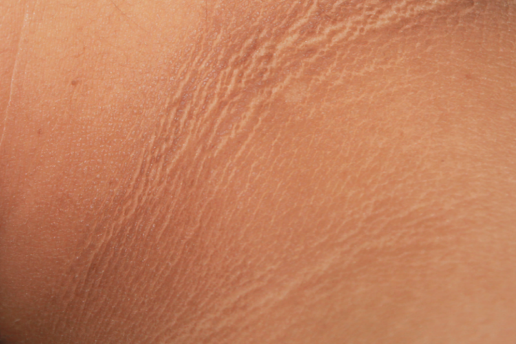 假性黑棘皮病皮肤表现图