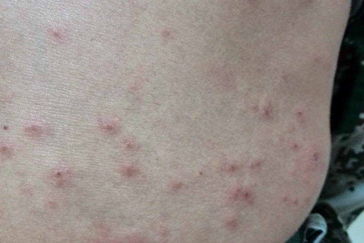 吃辣条身上起湿疹图