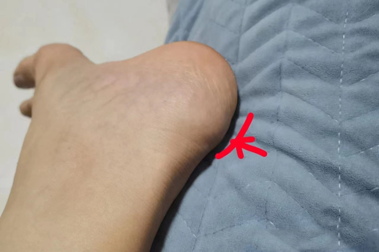 跟骨骨质增生图