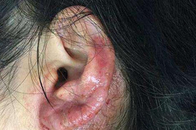 耳廓软骨膜炎症状图