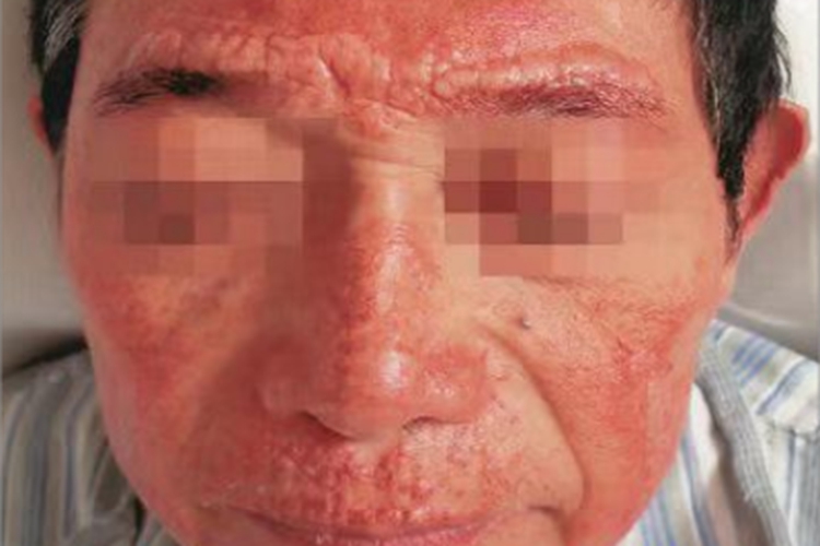 类脂质蛋白沉积症面部结节图