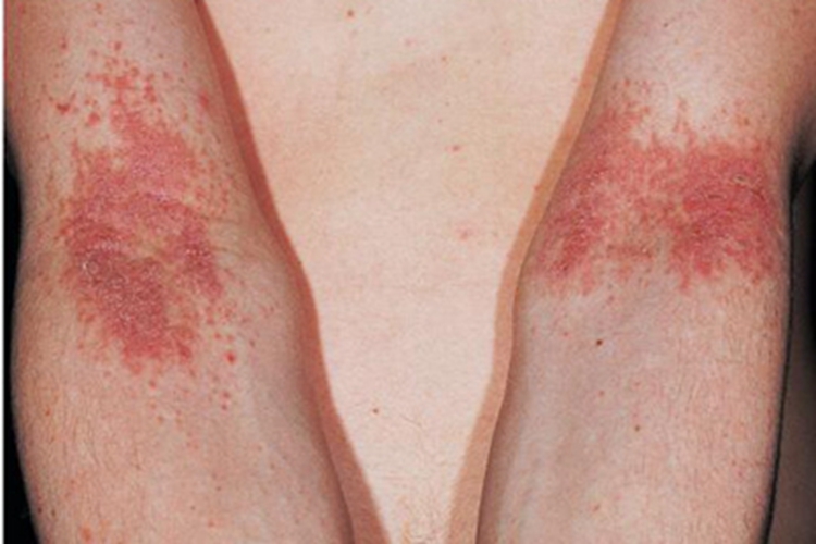 儿童期特应性皮炎胳膊丘疹图 儿童期特应性皮炎胳膊丘疹图